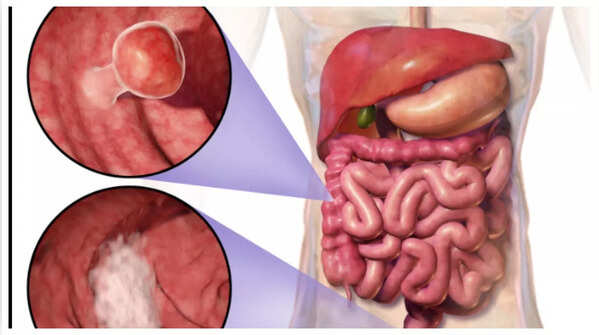 Close up of blood in stool, a sign of colon cancer